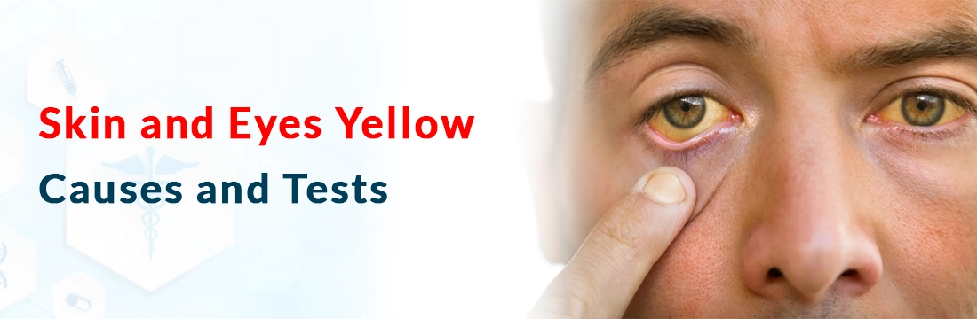  Skin and Eyes Yellow: Causes and Tests